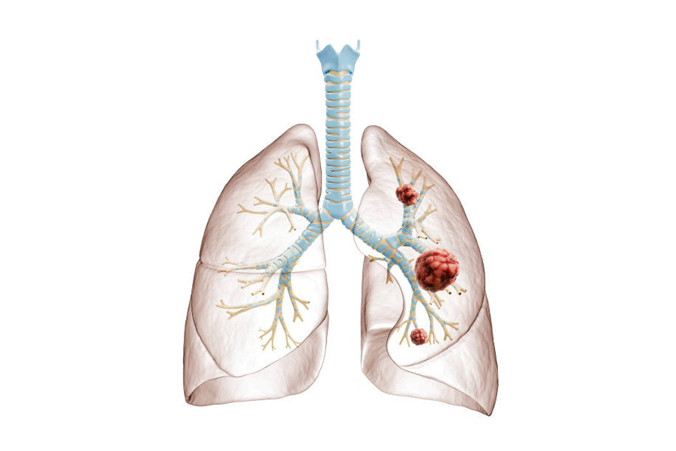 Чи можна вилікувати рак легень?